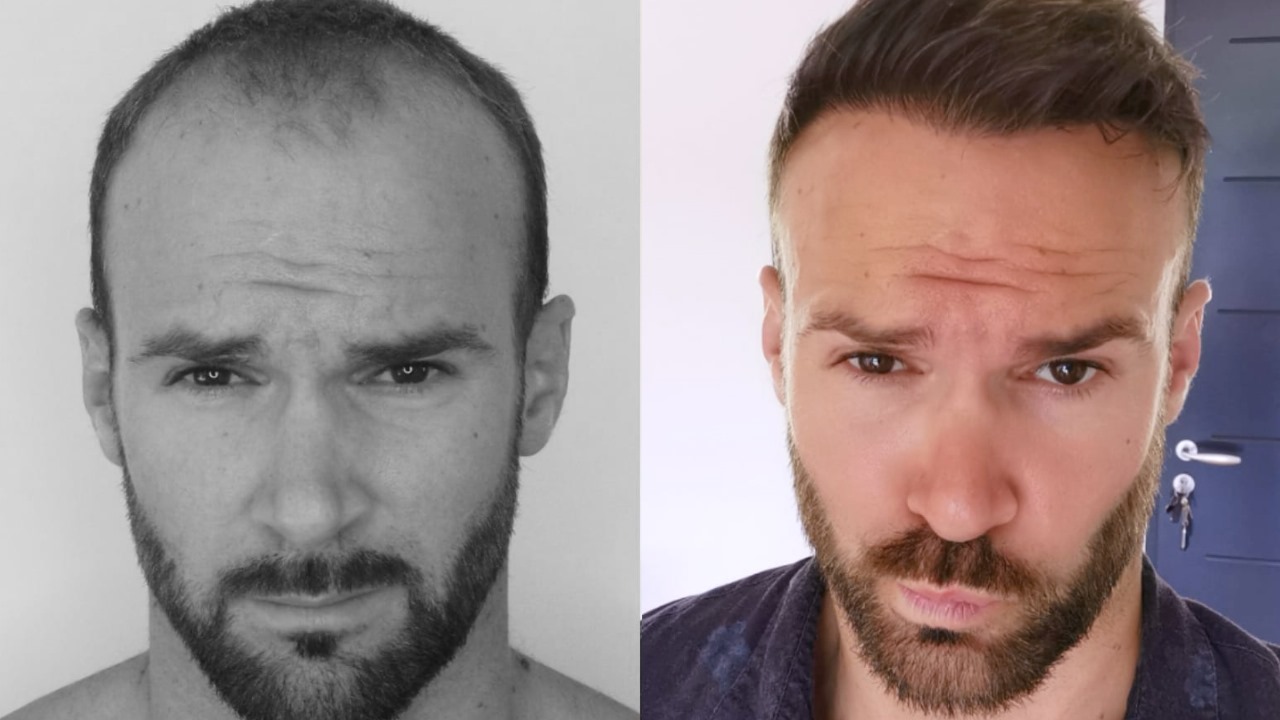 Hair Transplant London Clinic: Proven Results for Men &amp; Women