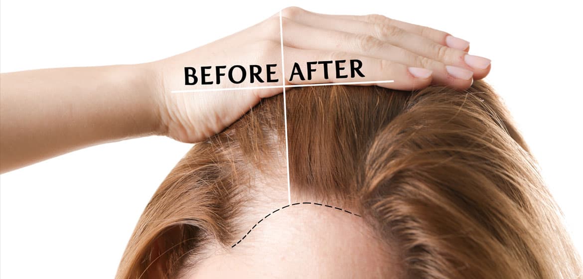 Hair Transplant Istanbul: Leading the Way in Cosmetic Excellence
